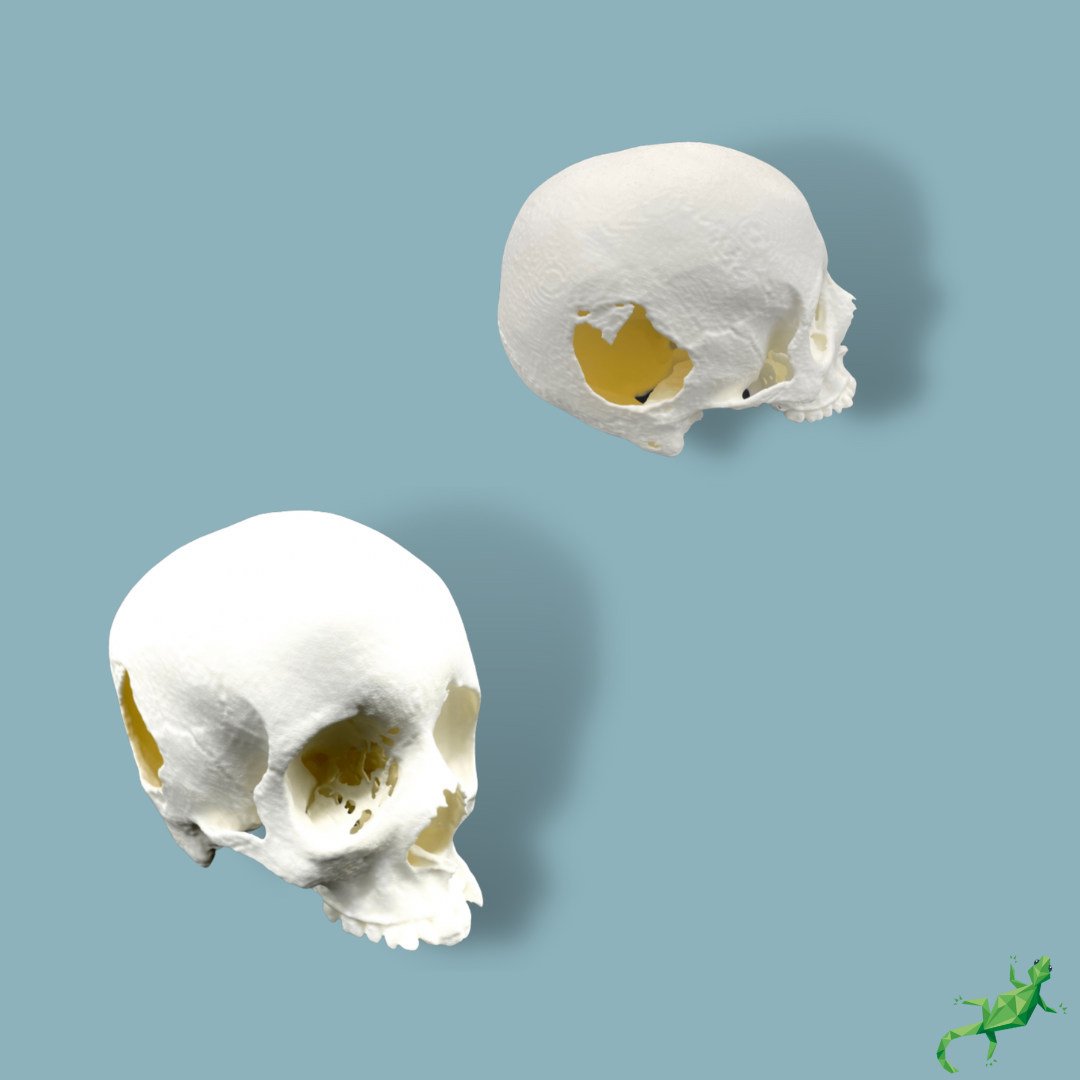 Crâne avec perte osseuse / Addi-CORT