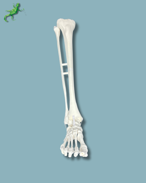 Foot and Tibia with a COFAS 1 Ankle arthritis, Addi-CORT+ - Ref 02-09-02