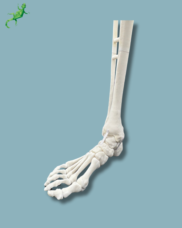 Foot and Tibia with a COFAS 1 Ankle arthritis, Addi-CORT+ - Ref 02-09-02 - Image 8