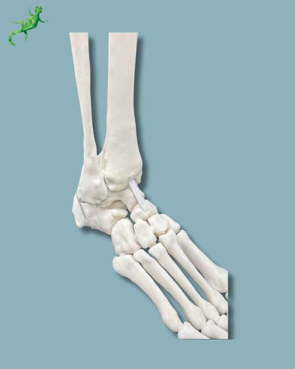 Foot and Tibia with a COFAS 1 Ankle arthritis, Addi-CORT+ - Ref 02-09-02 - Image 10