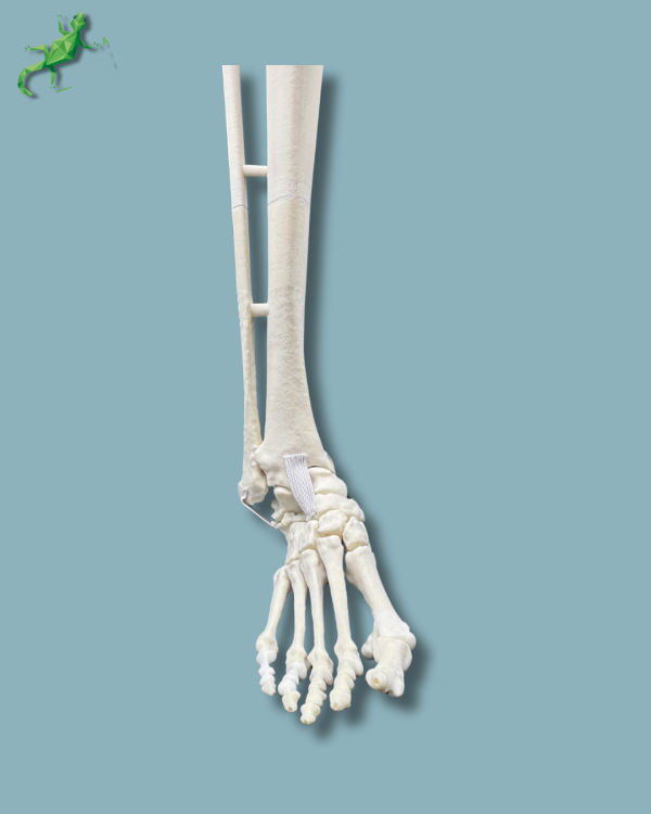 Foot and Tibia with a COFAS 2 varus ankle arthritis, Addi-CORT+ - Ref 02-10-02