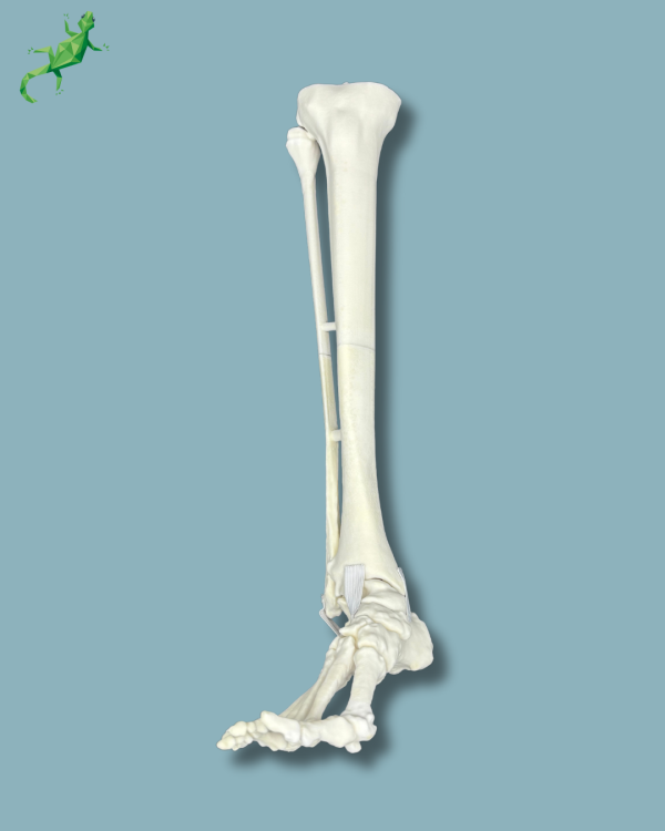 Pied et tibia avec une arthrose de la cheville varus COFAS 2, Addi-CORT+ - Ref 02-10-02 – Image 2