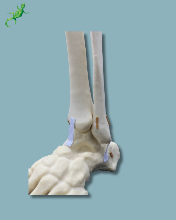 Foot-Ankle and Mid-Tibia and Fibula with fracture / Left / Addi-CAN - Ref 02-22-02 - Image 10