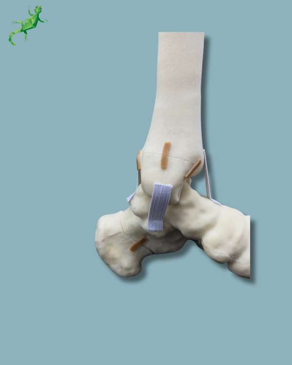 Foot-Ankle and Mid-Tibia and Fibula with fracture / Left / Addi-CAN - Ref 02-22-02 - Image 11