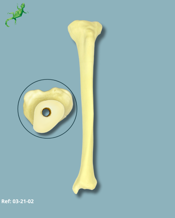 TIBIA / MEDIUM / LEFT / ADDI-CAN with intramedullar canal - Ref 03-21-02