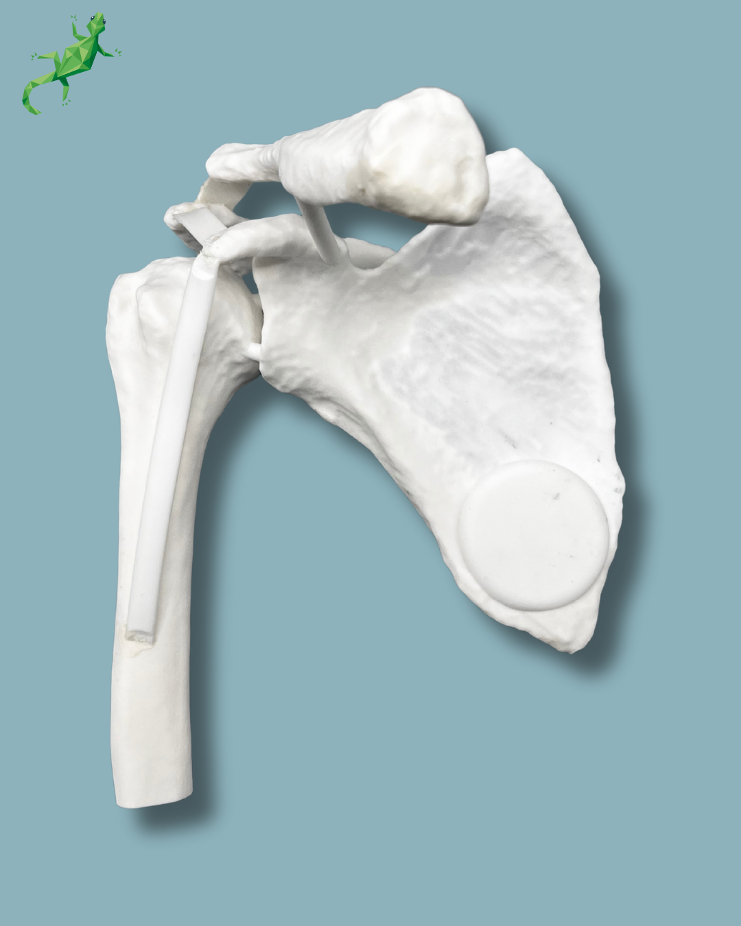 Épaule avec luxation de l&rsquo;articulation acromio-claviculaire, droit – Ref 16-09-01